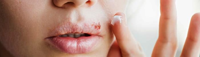 Снова беспокоит и болит! Советы фармацевта по борьбе с простудой на губах