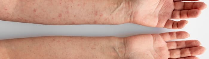 5 видов воспалений кожи летом – как их предотвратить? Объясняет фармацевт