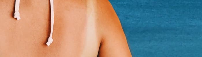 Starp dzīvību un nāvi jeb melanoma