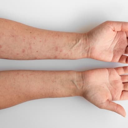 5 ādas iekaisumu veidi vasarā – kā tos novērst? Skaidro farmaceits