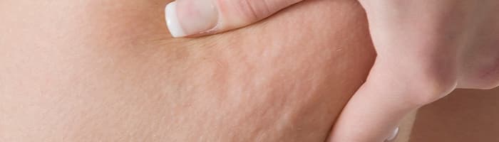 Hroniska vēnu mazspēja